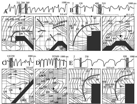 Ventricular ectopic beats in aged heart. In each panel, above ...