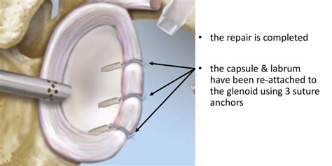 Bankart Repair