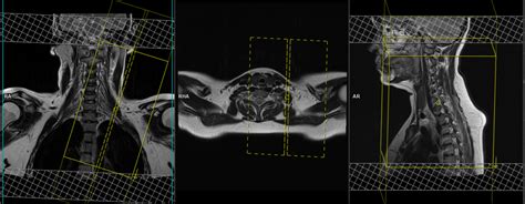 Brachial Plexus Anatomy Mri