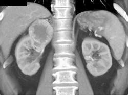 Renal Cell Carcinoma - Kidney Case Studies - CTisus CT Scanning