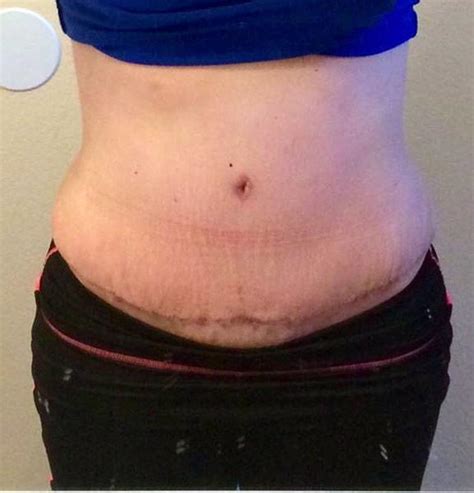 Tummy tuck scars photos after recovery » Tummy Tuck: Prices, Photos ...