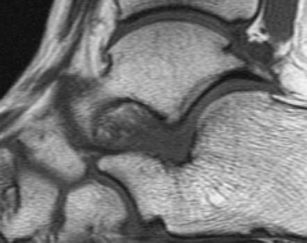 Sinus Tarsi Mri