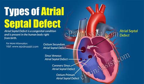 Atrial Septal Defect Fetal Ultrasound