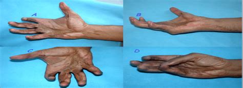 Degloving Injury of Palm & Digits