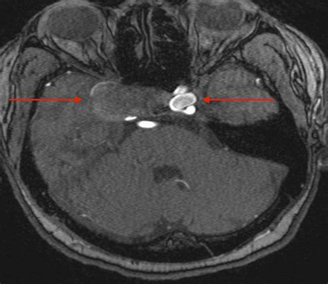 Cureus | Spontaneous Thrombosis of a Giant Cavernous Internal Carotid ...