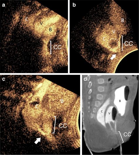 Cloacal malformation in a 3-month-old girl. a–c Contrast-enhanced ...