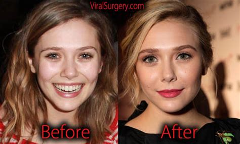 Elizabeth Olsen Plastic Surgery: Before and After Nose Job, Botox Pictures