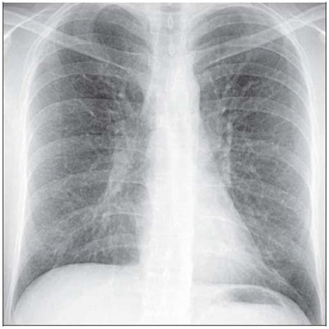 Asthma | Radiology Key