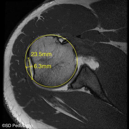 Hill Sachs Lesion Radiology