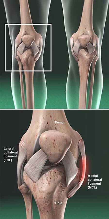 Medial Collateral Ligament (MCL) Injury | Central Coast Orthopedic ...