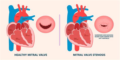 Mitral Valve Diagram