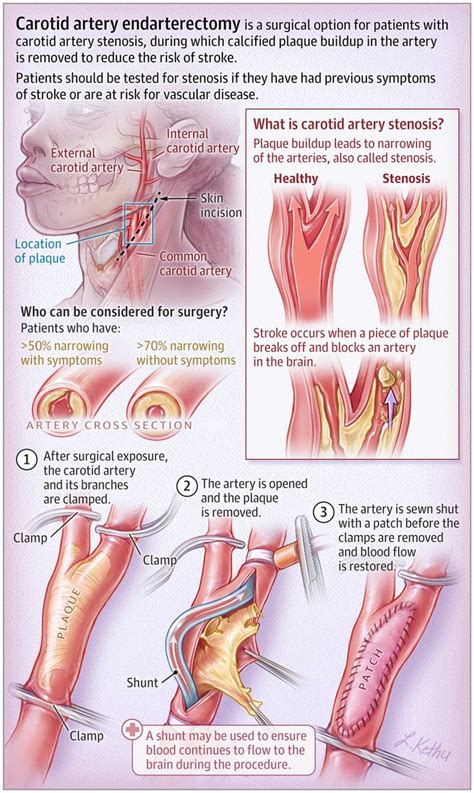 Carotid Artery Endarterectomy | Carotid artery, Arteries, Medical