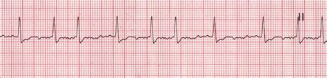 Atrial fibrillation