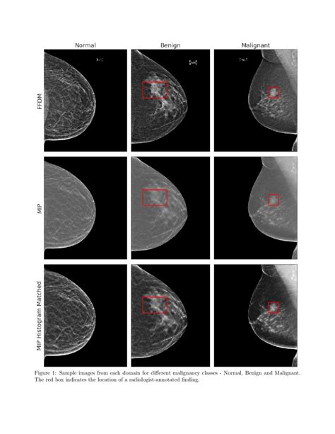 Adaptation of a deep learning malignancy model from full-field digital ...