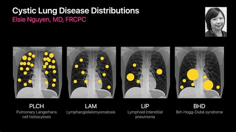 Distribution can help... - Society of Thoracic Radiology | Facebook