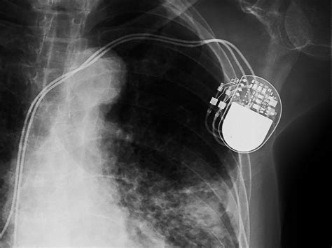 A New Pacemaker Hack Puts Malware Directly On the Device | WIRED