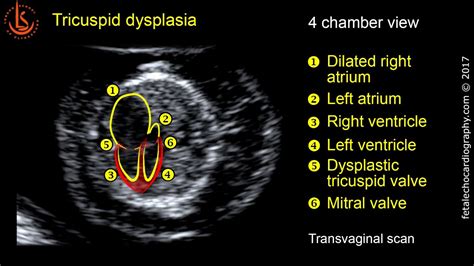 Tricuspid regurgitation cardiograph - kesilposters