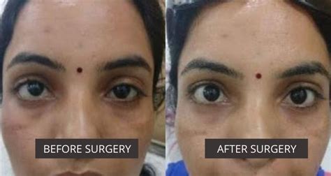 Superior Oblique palsy| Nerve Palsy | Squint | Eye Solutions