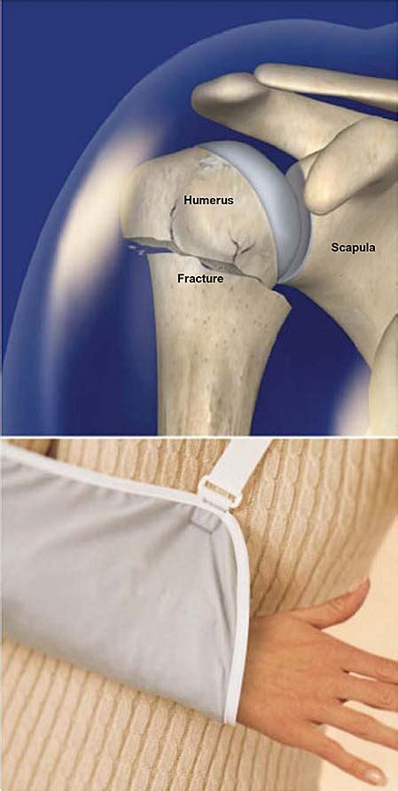 Proximal Humerus Fracture (Broken Shoulder) | Central Coast Orthopedic ...