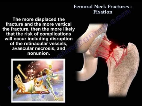 Femoral Neck Fracture