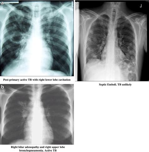 Tuberculosis Vs Pneumonia X Ray