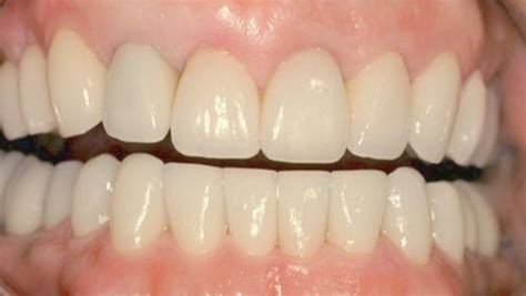 Papilla Reconstruction | Dr. Peter Nordland | Periodontist