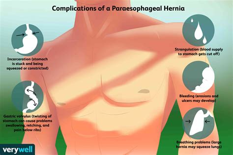 Paraesophageal Hiatal Hernia: Symptoms and Treatments