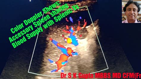 Accessory Spleen on ultrasound, don't mistake as lymph node, Splenule ...