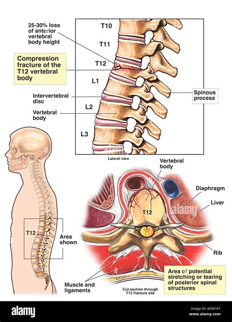 Compression Fracture Diagram