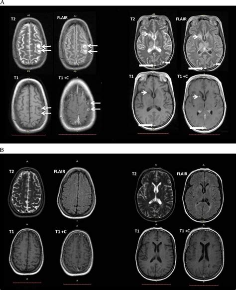 What Is T1 And T2 MRI