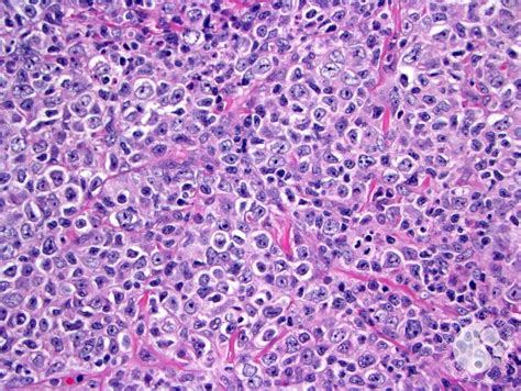 Follicular lymphoma, grade 3B 9