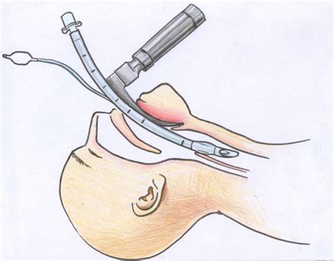 Intubation procedure: Video ~ MedchromeTube - Best Medical Videos