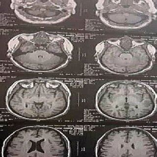 Brain MRI Showing Partial Empty Sella Features, with Enhanced Fluid ...