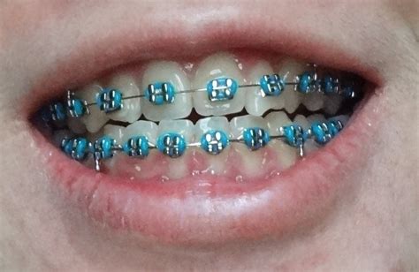 1000+ images about Braces Colors on Pinterest | Braces, Braces colors ...