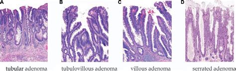 Villous Adenoma Vs Tubular Adenoma