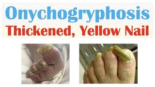 Onychogryphosis Causes