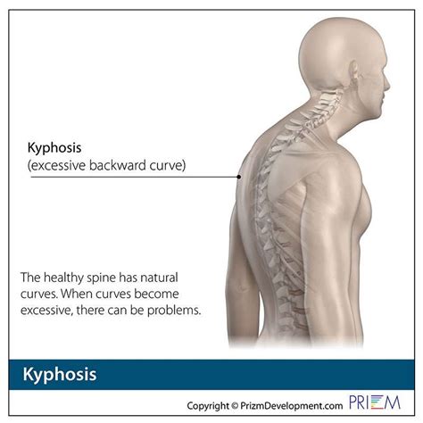 Kyphosis Treatment Reno and Carson City | Swift Institute