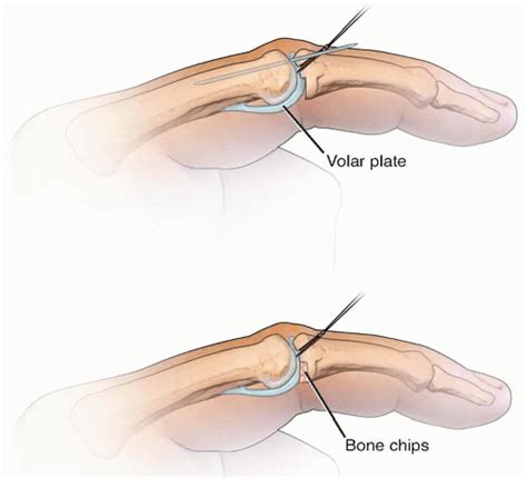 Volar Plate Arthroplasty | Musculoskeletal Key