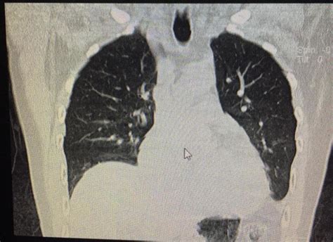 Lung computed tomography shows no evidence of active COVID-19 infection ...