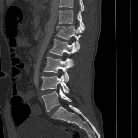 C-spine x-ray interpretation