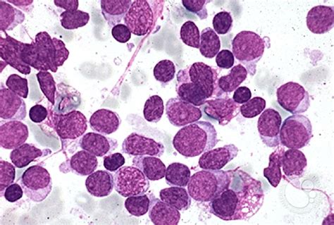 Precusor B-cell Acute Lymphoblastic Leukemia - 8.