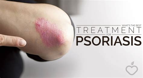 New treatment for psoriasis