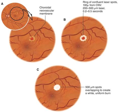 Thermal laser photocoagulation - American Academy of Ophthalmology