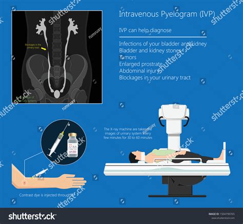 Intravenous Pyelogram Procedure, Indications, Prep,, 52% OFF