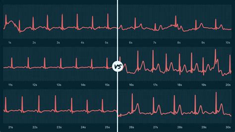 Sinus Arrhythmia Vs. Atrial Fibrillation on Your Watch ECG | Qaly