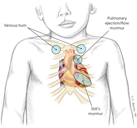 Heart Murmurs in Children: Evaluation and Management | AAFP