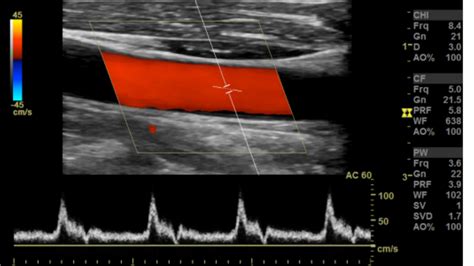 Lower Extremity Arterial Ultrasound Criteria