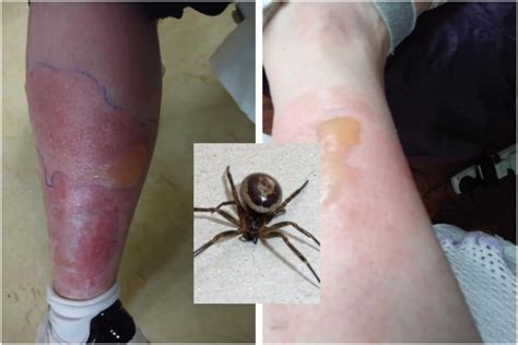 Insect expert warns of dangers of Noble False Widow spiders after two ...