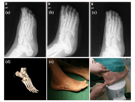 Tuberosity Of 5th Metatarsal Pain