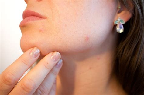 How to Treat the Most Common Bacterial Skin Infections?